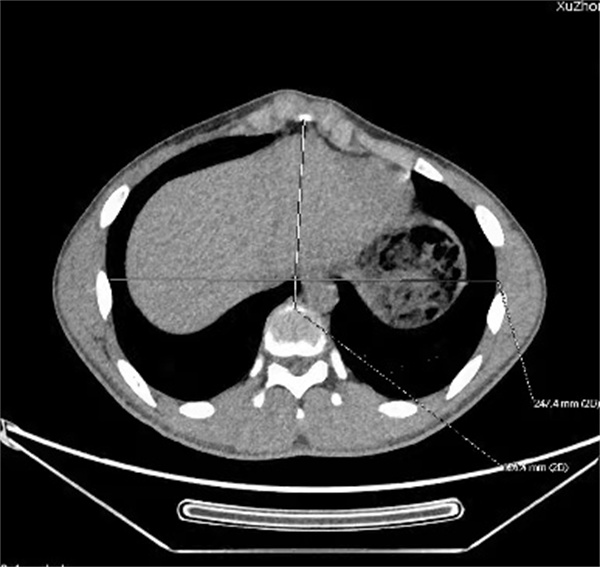 徐州市儿童医院专家提醒：关注儿童及青少年胸壁隆起——鸡胸